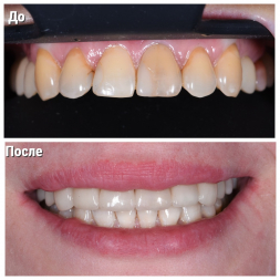Виниры – это одно из самых надежных, долговечных и проверенных решений в современной эстетической стоматологии.